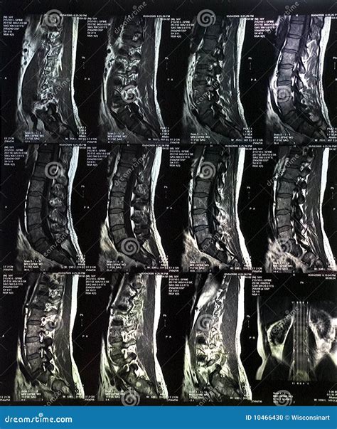 Mri Scan Spine