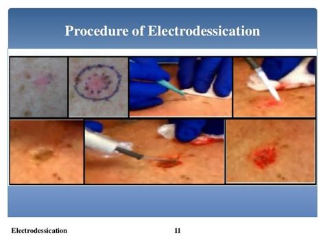 Electrodesiccation