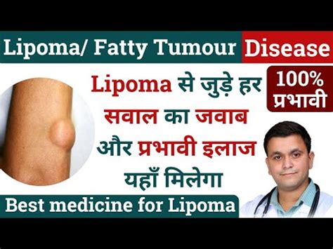 Homeopathic Treatment For Lipoma Charbi Ki Ganth Lipoma Homeopathic