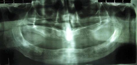 Giant Submandibular Sialolith Of Remarkable Size In The Comma Area Of