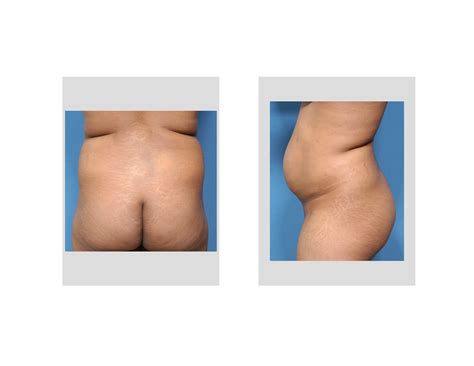 Muffin Top Liposuction Before Surgery Dr Barry Eppley Indianapolis