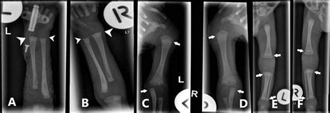 Long Bone Radiographic Abnormalities Of Congenital Syphilis In A