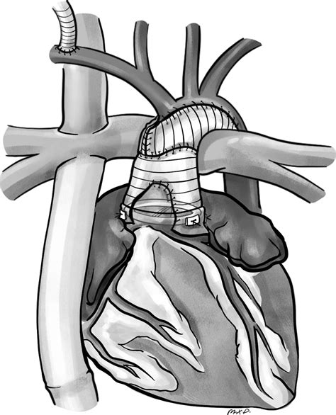 A new surgical… | The American Association for Thoracic Surgery | AATS