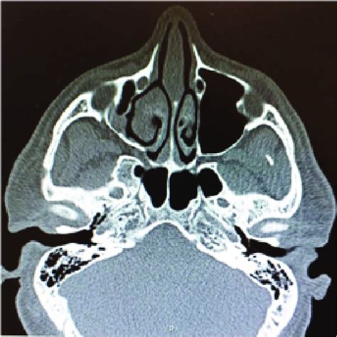 Axial Computed Tomography It Demonstrated Dimensional Asymmetry Of The