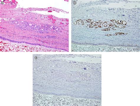 Shows Histologic Sections From A Thyroglossal Duct Cyst Ah E Stained