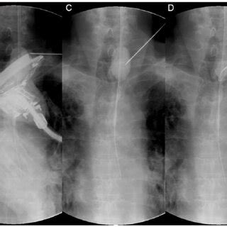 Clinical Outcomes After Percutaneous Transesophageal Gastro Tubing