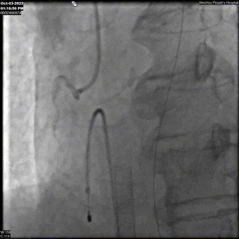 Ecmo Tavr Pci