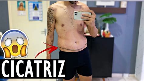 VLOG COMO FICOU A CICATRIZ DA CIRURGIA Menino Prendado YouTube