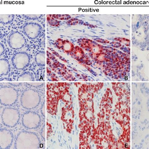 Immunohistochemical Staining For β Catenin A C And Cyclin D1 D Download Scientific