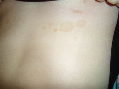 red blotchy skin on chest - pictures, photos