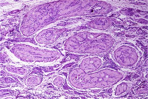 Sex Cord Stromal Tumors Of The Testis Diagnostic Histopathology