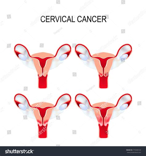 Cervical Cancer Staging Carcinoma Cervix Malignant Stock Illustration