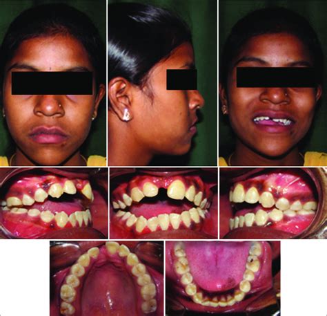 Pretreatment Extraoral And Intraoral Photographs Showing Missing