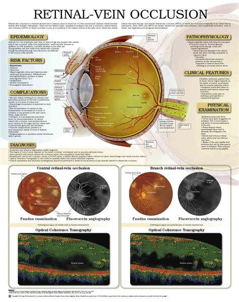 Retinal-vein occlusion – Anejo