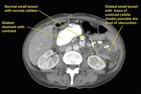 Bowel Obstruction After Duodenal Switch Dssurgery