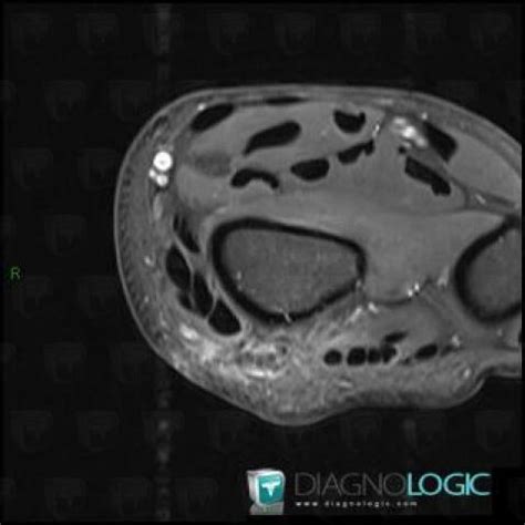 Extensor Pollicis Longus Mri