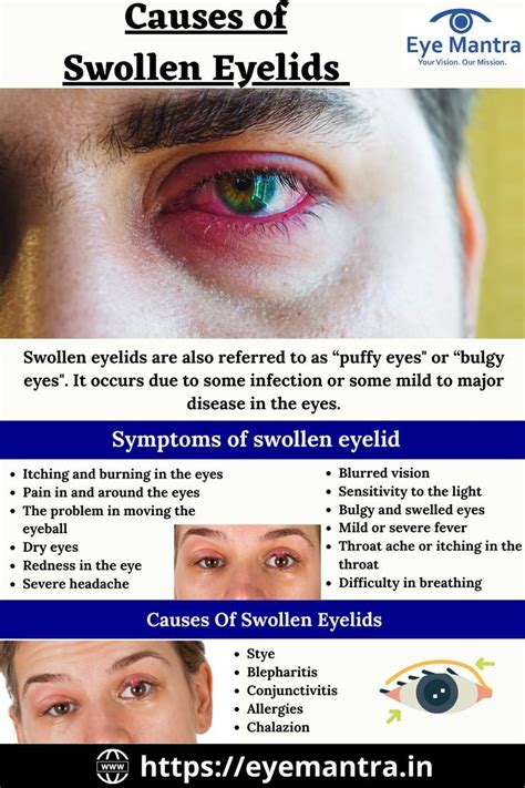 5 Causes Of Swollen Eyelids How To Get Rid Of Puffy Eyelids