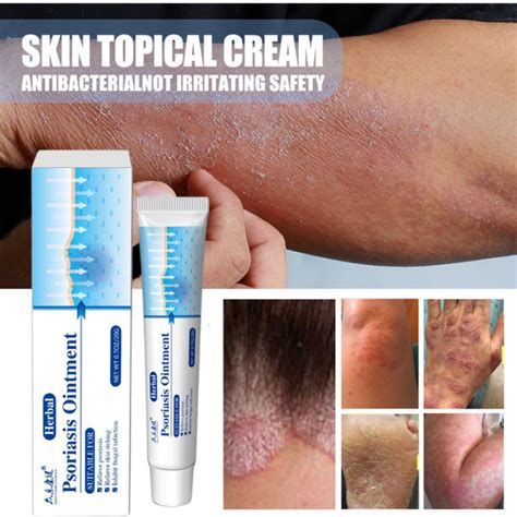 Hot Sale】antibacterial Psoriasis Cream Herbal Treatment Eczema Relief