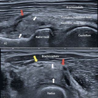 Ultrasonography imaging of the left supinator injury and the hematoma... | Download Scientific ...