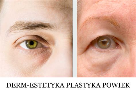 Plastyka powiek dolnych Derm Estetyka Gdynia Gdańsk