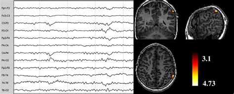 Eeg Fmri Study Of The Interictal Epileptic Activity In Patients With