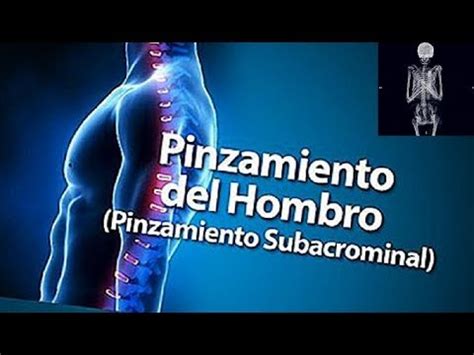 S Ndrome De Pinzamiento Patologias Mas Frecuentes En Hombro