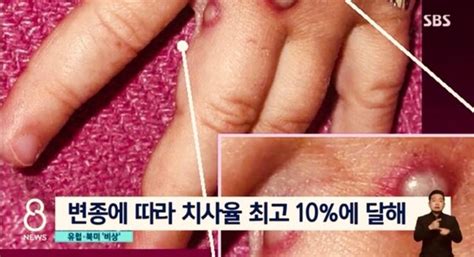 원숭이두창 중동서 첫 발견증상과 감염원인은