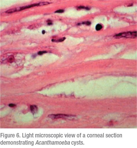 Acanthamoeba The Keratitis That Wont Quit