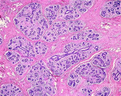 Adenosis Of Human Breast 9 By Jose Calvo Science Photo Library