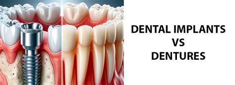 The Dental Implants vs Dentures Guide: Costs, Pros & Cons