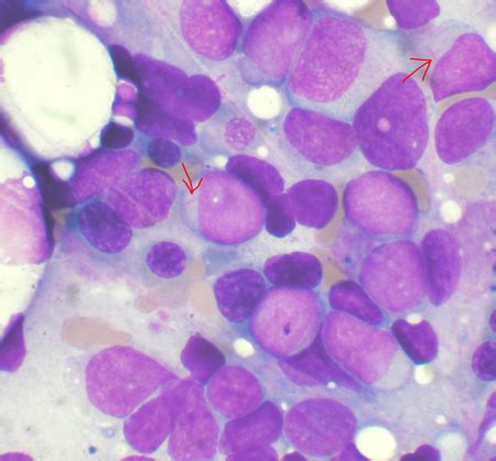 Acute Myeloid Leukemia Libre Pathology