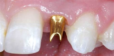 Platinum Gold Teeth