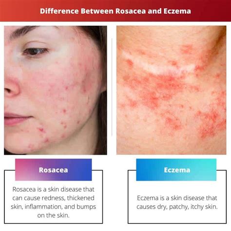 Rosacea Vs Eczema Difference And Comparison