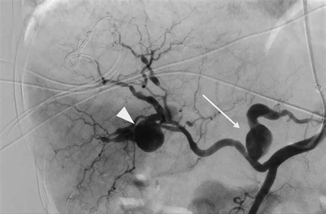 Celiac artery angiogram image showing the pre-embolization image of... | Download Scientific Diagram