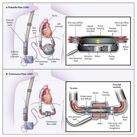 Advanced Heart Failure Treated With Continuous Flow Left Ventricular