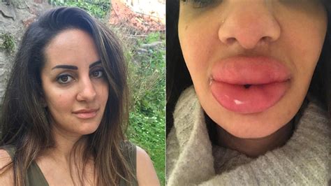 What Causes Big Swollen Lips