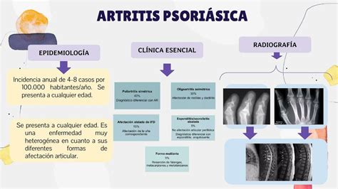 Artritis Psoriásica Middlemedic Udocz