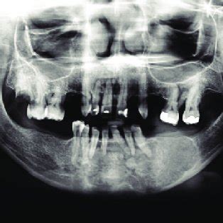 Panoramic Radiograph Indicates The Left Mandibular Multilocular