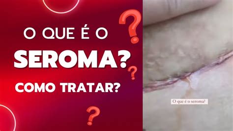 Seroma pós cirúrgico como tratar Líquido amarelado após cirurgia