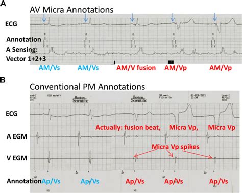 Long Term Synchronization Of Old Transvenous Dual Chamber Pacemaker And Newly Implanted Leadless