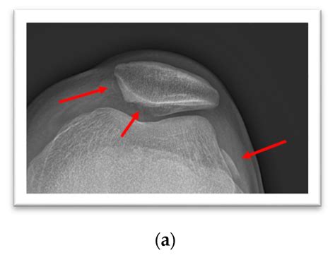 Life Free Full Text Reconstruction Of Large Osteochondral Lesions