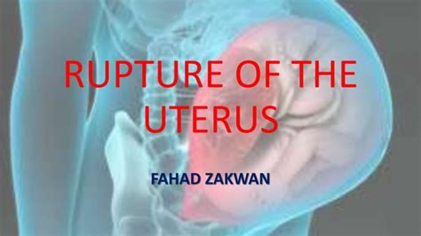 Rupture of the uterus | PPT