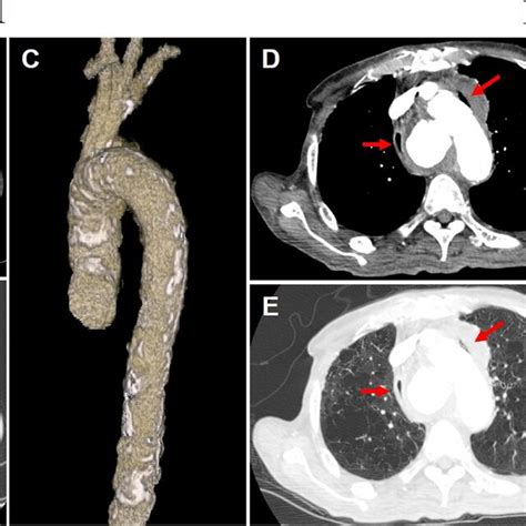 a, b A chest computed tomography (CT) showing mediastinal emphysema... | Download Scientific Diagram