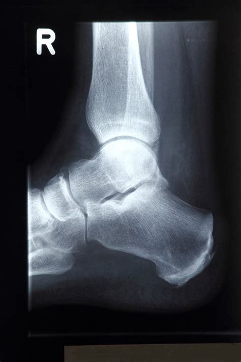 X-ray of the foot, ankle stock image. Image of medicine - 133893735