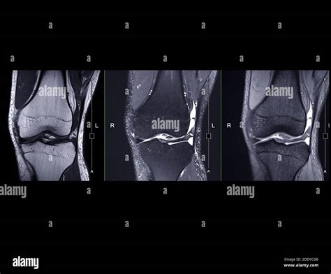 Mrt kniegelenk sagittal Fotos und Bildmaterial in hoher Auflösung Alamy