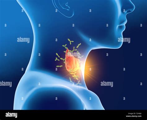 Medically 3d Illustration Showing Antibodies Attacking Thyroid Gland Of