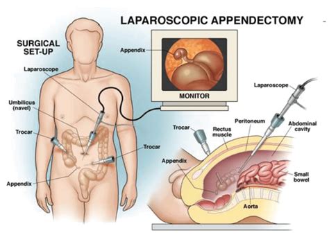 laparoscopic appendectomy surgery doctor  warangal vasavi