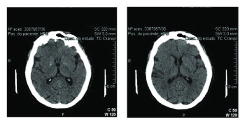 Tomografia Computadorizada De Cr Nio Sem Contraste Horas Do