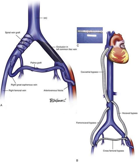 Femoral Bypass Graft