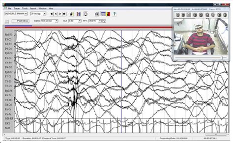 The Eeg Recording Showed Alpha Activity Normal Cardiac Rhythm And